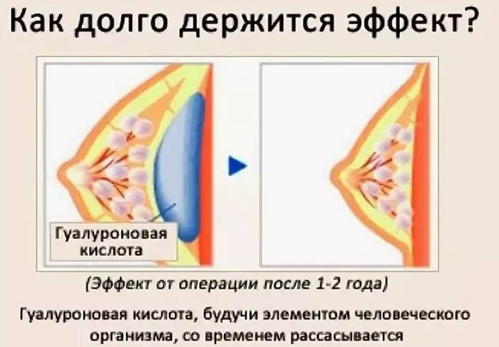 Увеличение молочных желез: как сделать грудь больше?