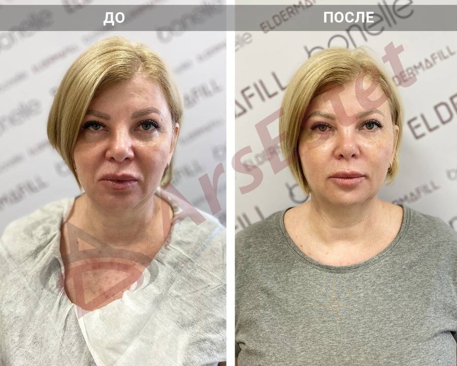 Мезоботокс: показания, противопоказания, методика инъекций, отзывы