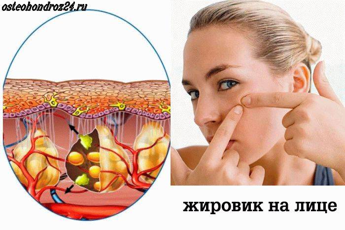 Как избавить лицо от жировиков - sunnyface
