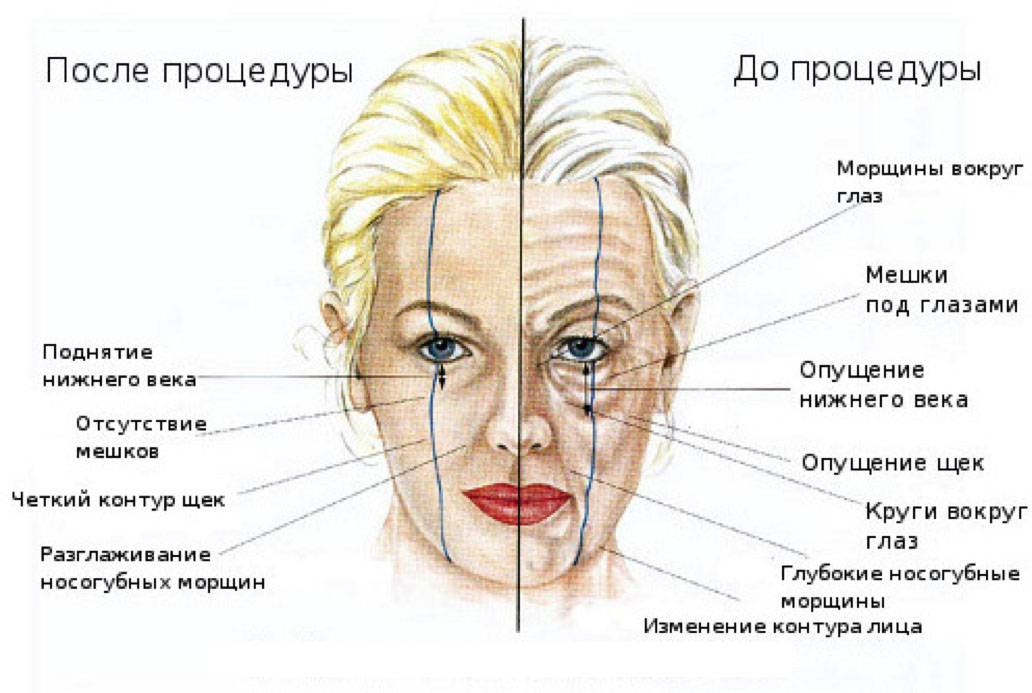 Подтяжка шеи: обзор методов