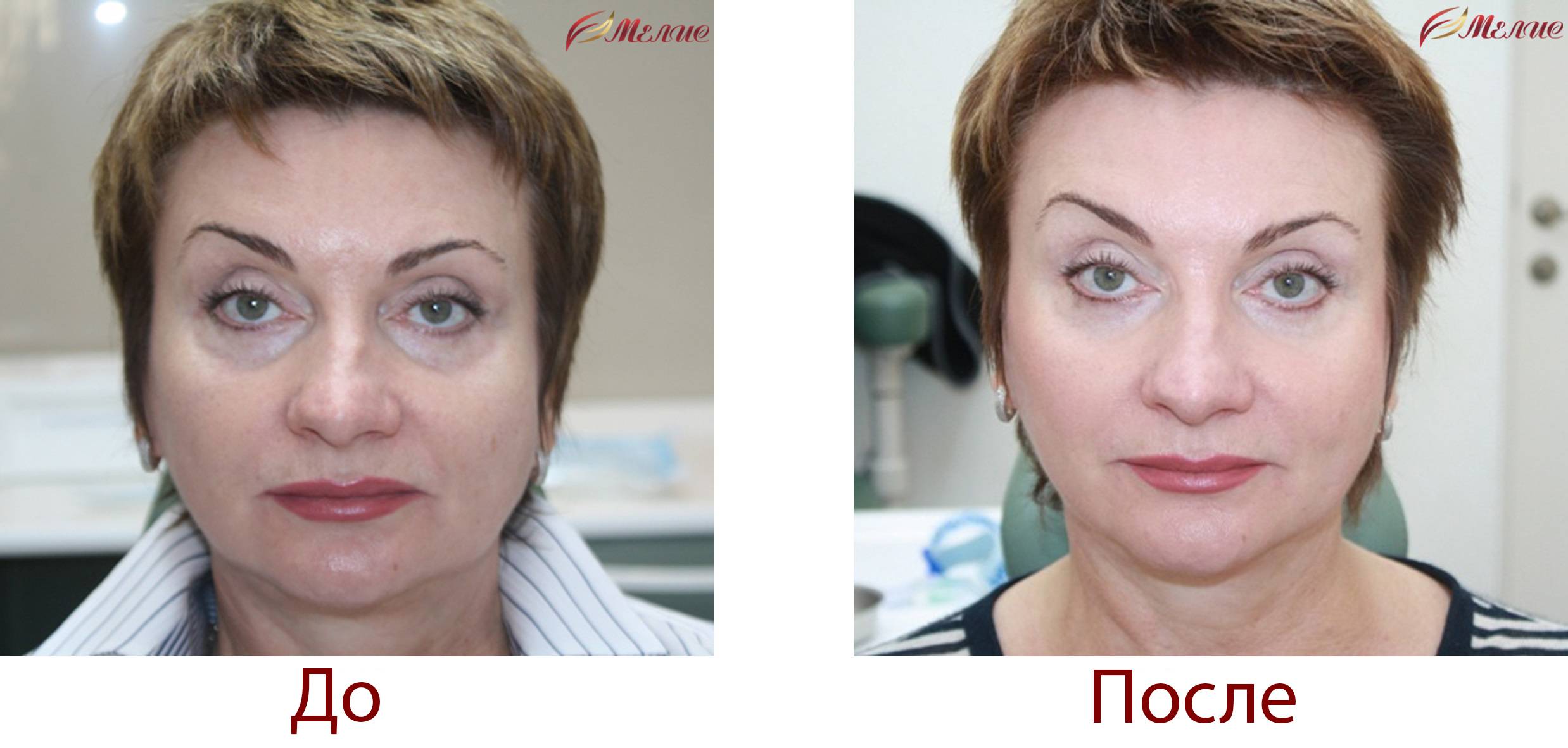 Плазмолифтинг для лица - что это такое в косметологии, эффект от процедуры, что она дает, как делают, плюсы и минусы