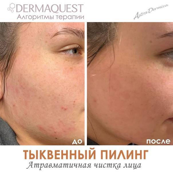 Тыквенный пилинг в салоне и в домашних условиях - читать