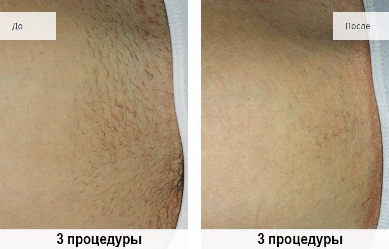 Электроэпиляция подмышек: отзывы, техника и количество сеансов