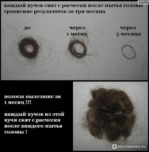 Норма выпадения волос у женщин за один день, причины облысения и профилактика