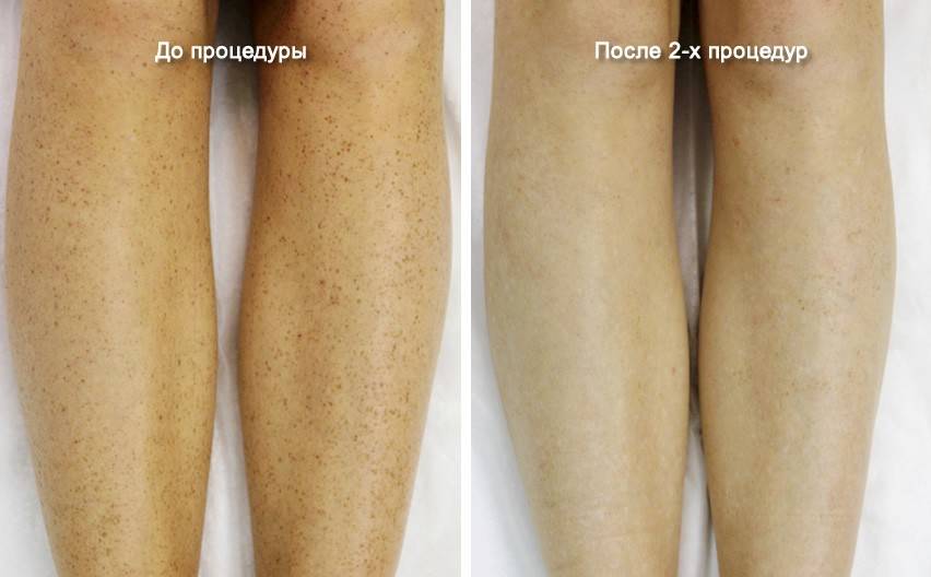Потемнение кожных покровов