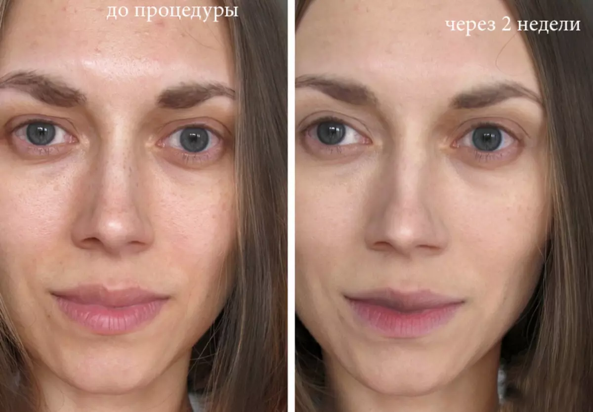 Bb glow: что это за процедура? каких результатов ждать?