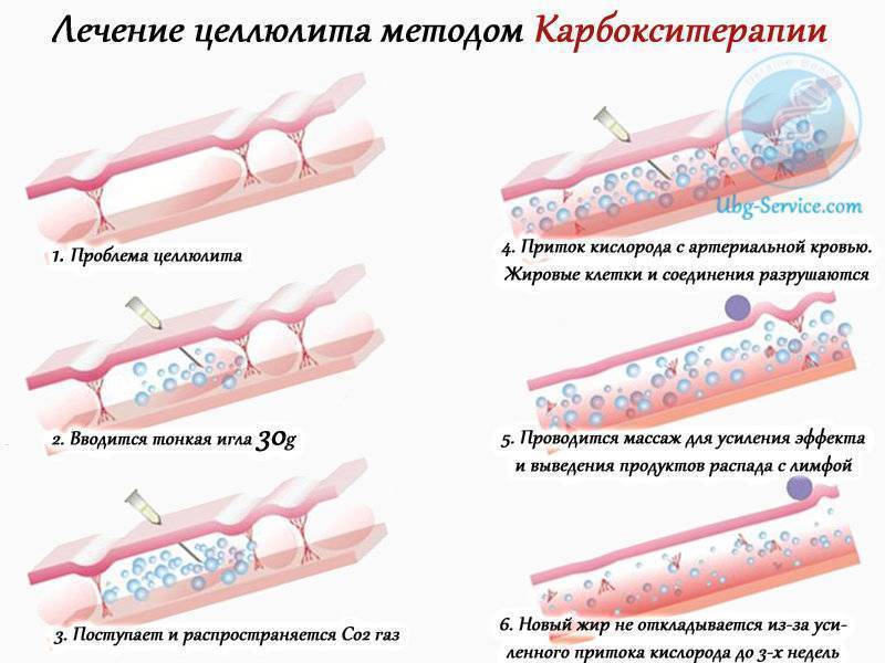 Что такое карбокситерапия