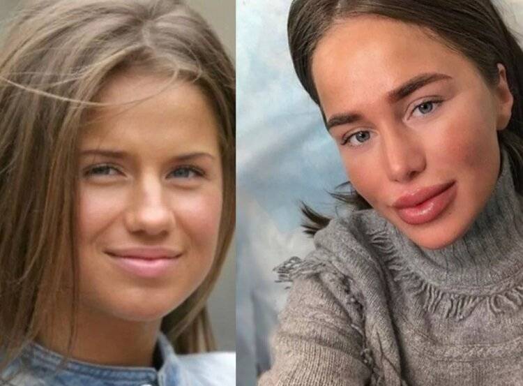 Российские звезды до и после пластики на фото