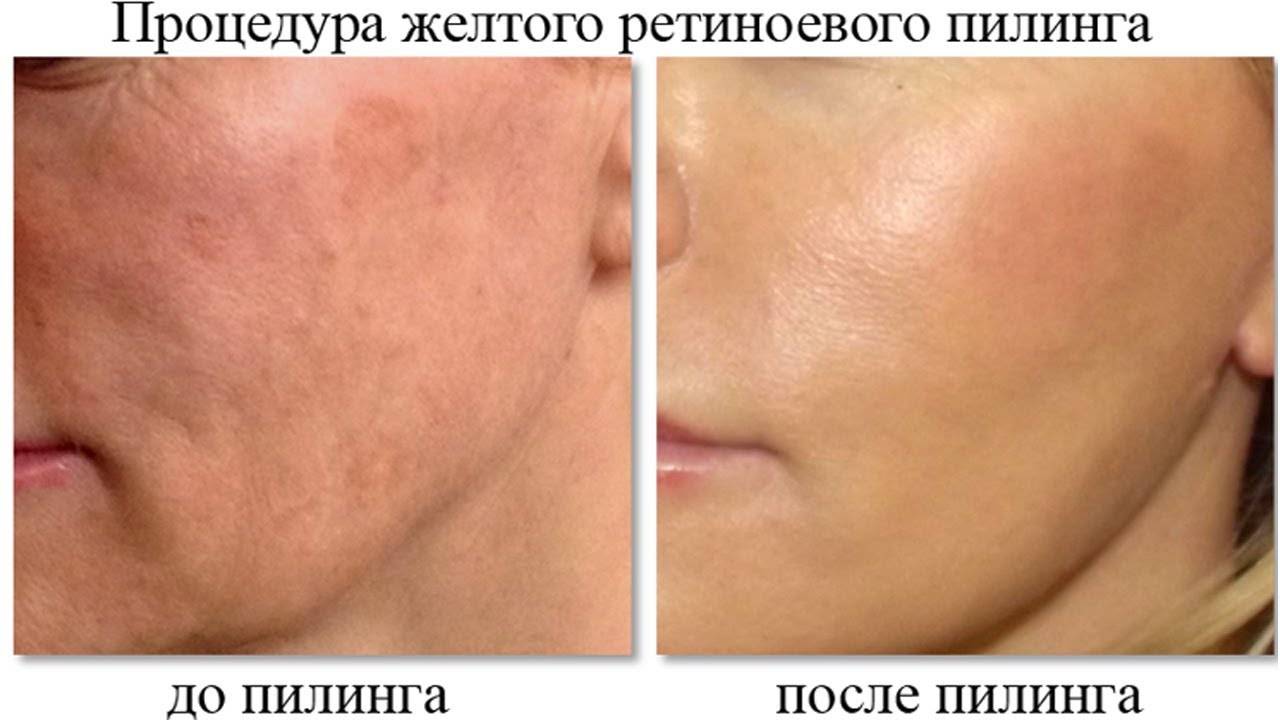 Ретиноевый пилинг