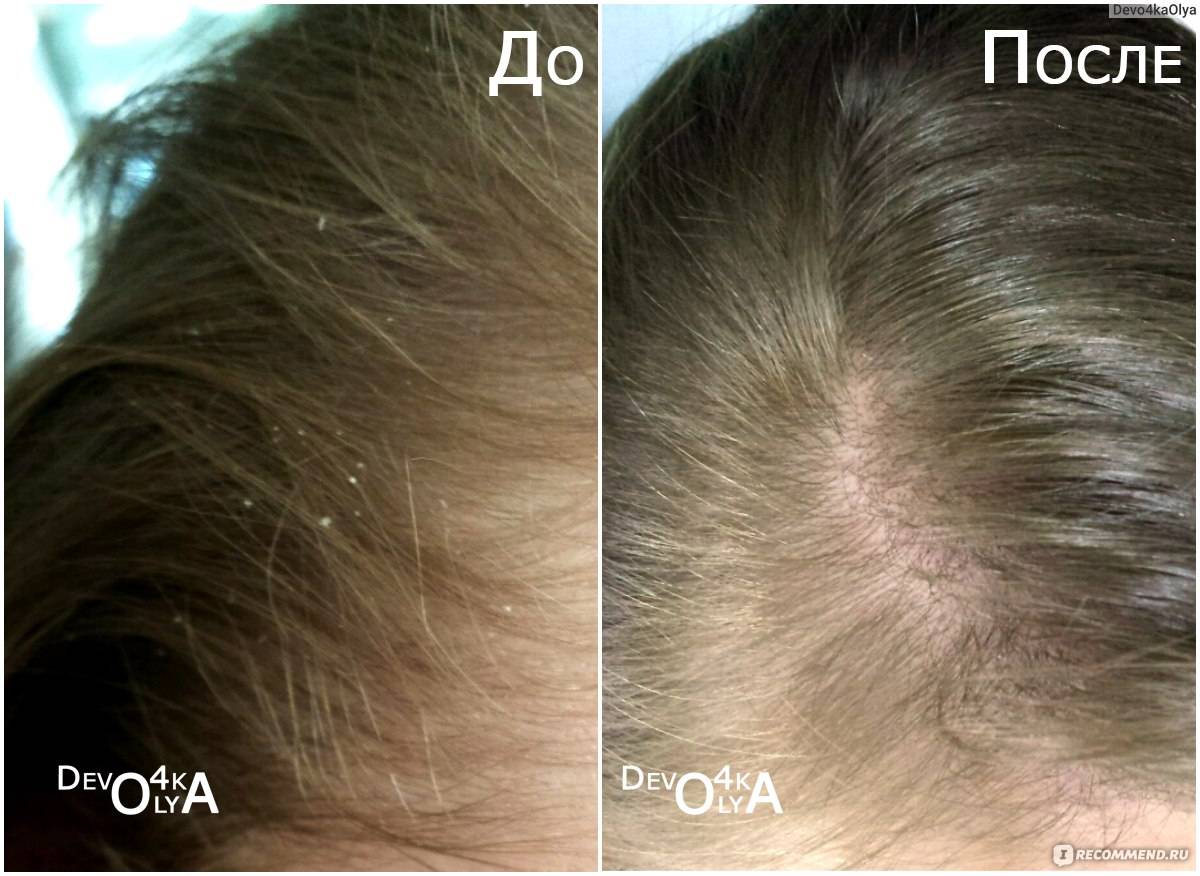 Чайное дерево для волос: польза, применение от выпадения и для роста