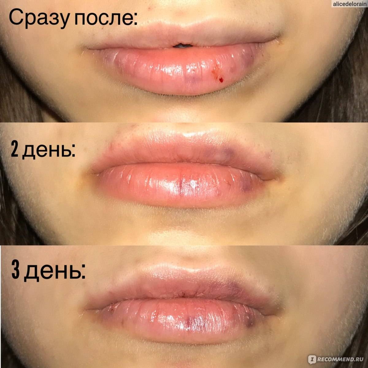 Что нельзя делать после увеличения губ
