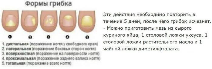 Как вылечить грибок ногтей йодом