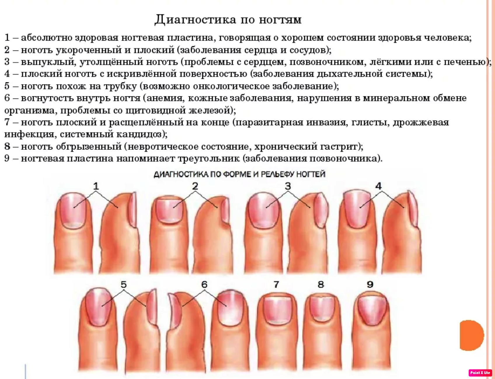 Как определить болезнь по ногтям