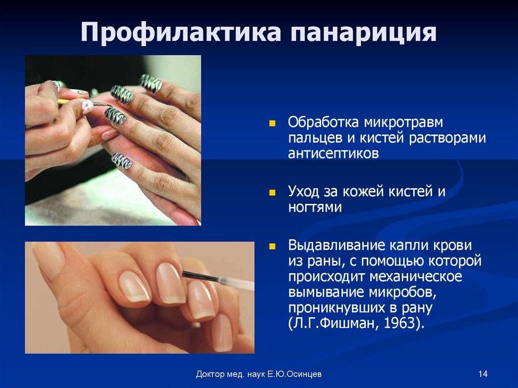 Панариций на пальце руки, ноги, формы панариция, симптомы и лечение панариция 