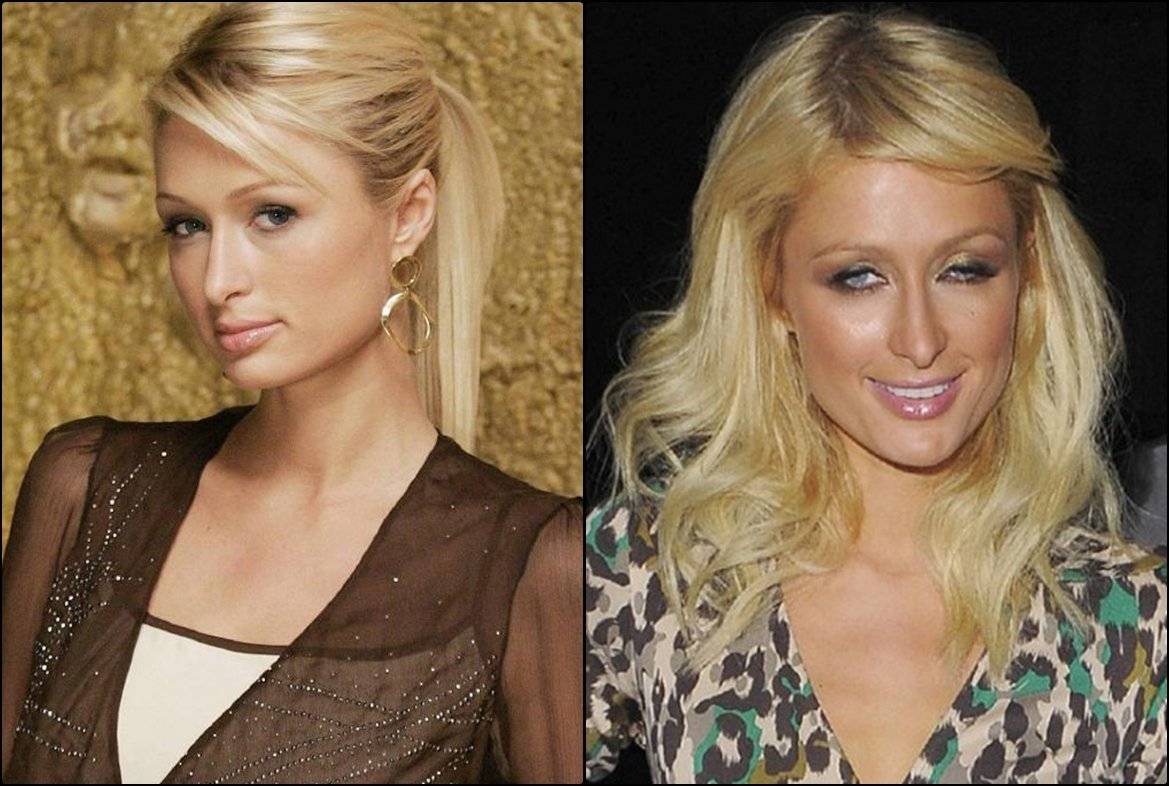 Paris hilton plastic surgery journey - vanity