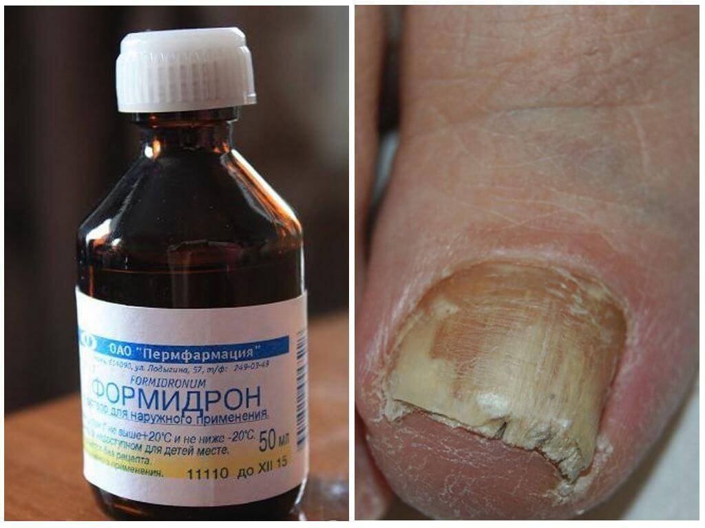 Как избавиться от грибка на ногтях ног быстро в домашних условиях