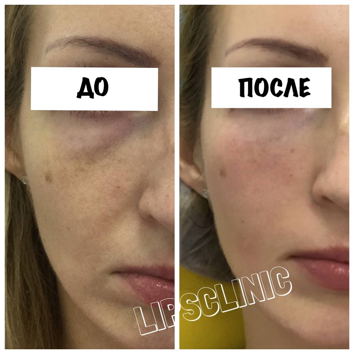 Дермахил (dermaheal) от мешков под глазами: эффект от применения и противопоказания