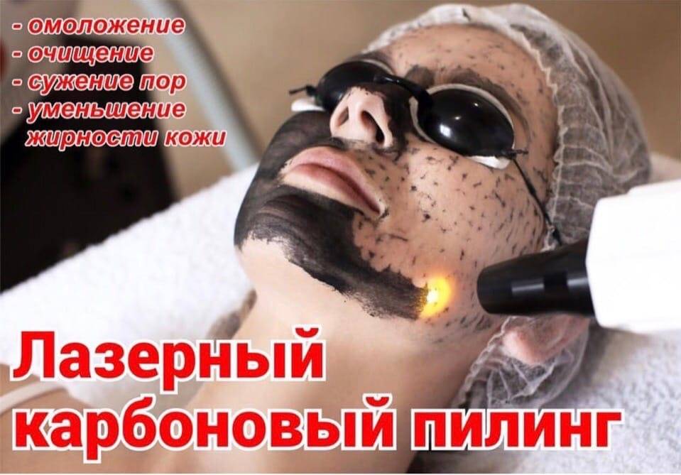 Карбоновый пилинг