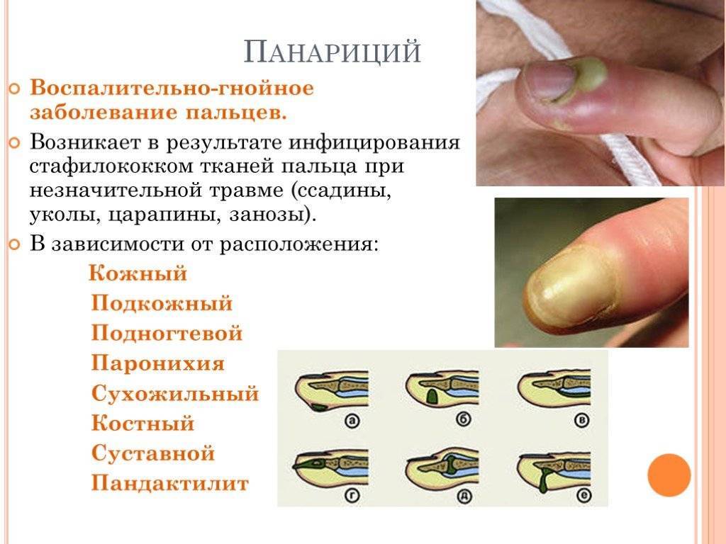 Причины, симптомы и лечение панариция. амбулаторная хирургия во владивостоке