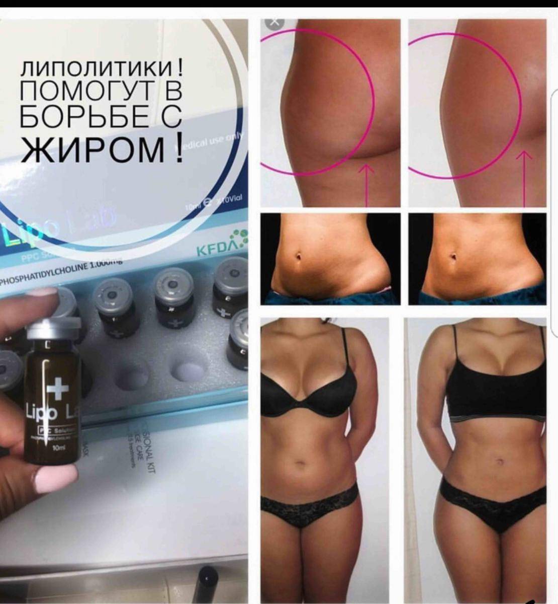 Что такое мезотерапия: описание процедуры, отзывы, фото до и после, результаты и эффект от мезотерапии