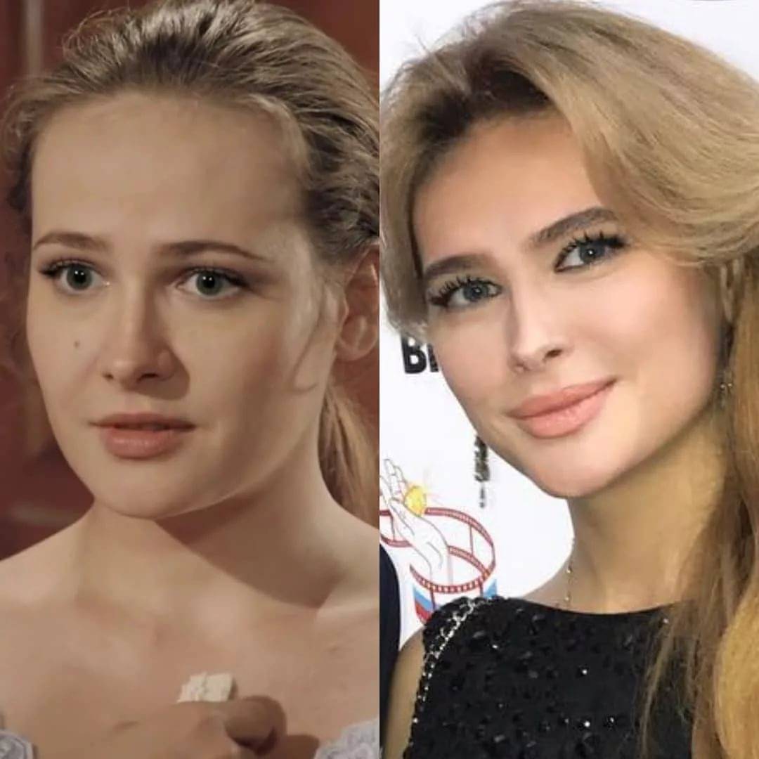 Анна горшкова фото до и после пластики