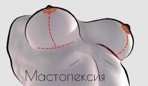Якорная подтяжка груди: преимущества и недостатки