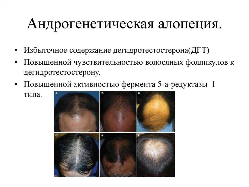 Очаговая алопеция: признаки и методы борьбы