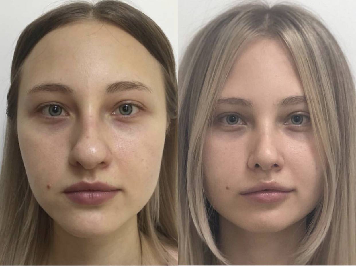 Ринопластика кончика носа. Цена, отзывы