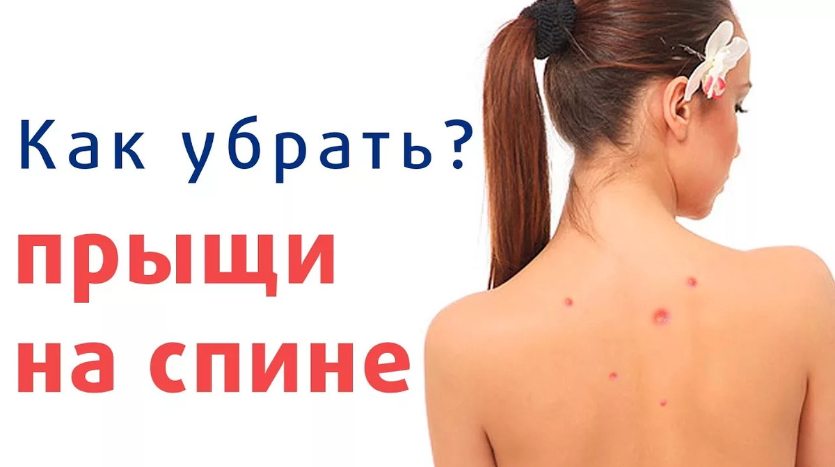 Акне на спине