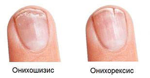 Слоятся ногти на руках: причины и лечение