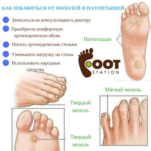 Сухие мозоли на пальцах ног: народное лечение