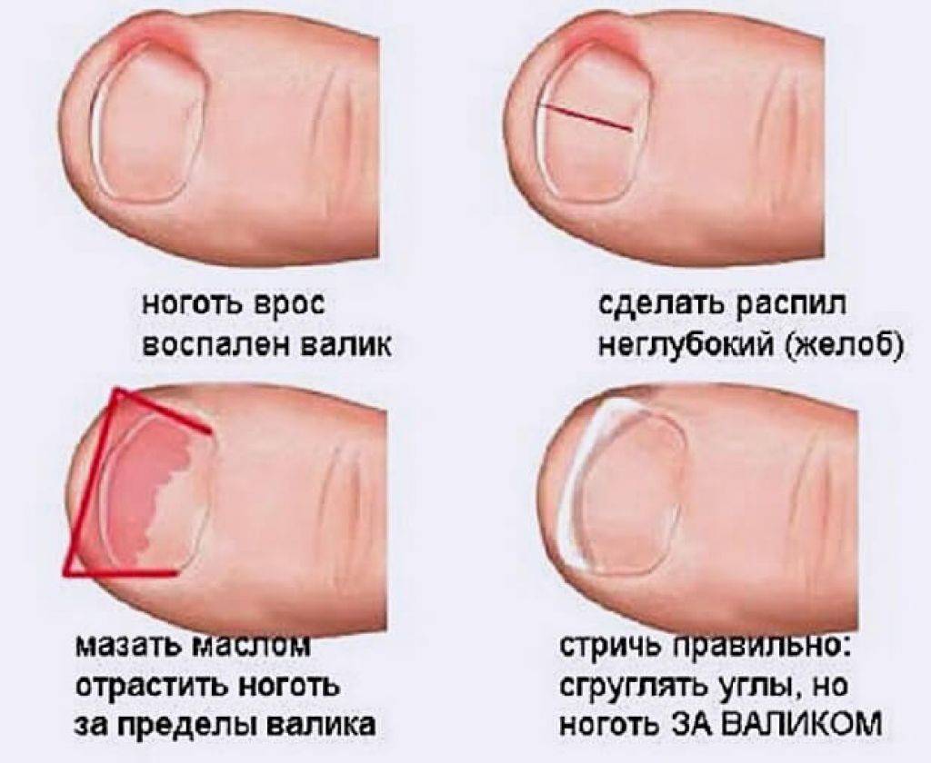 Что делать если нарывает палец? причины и лечение