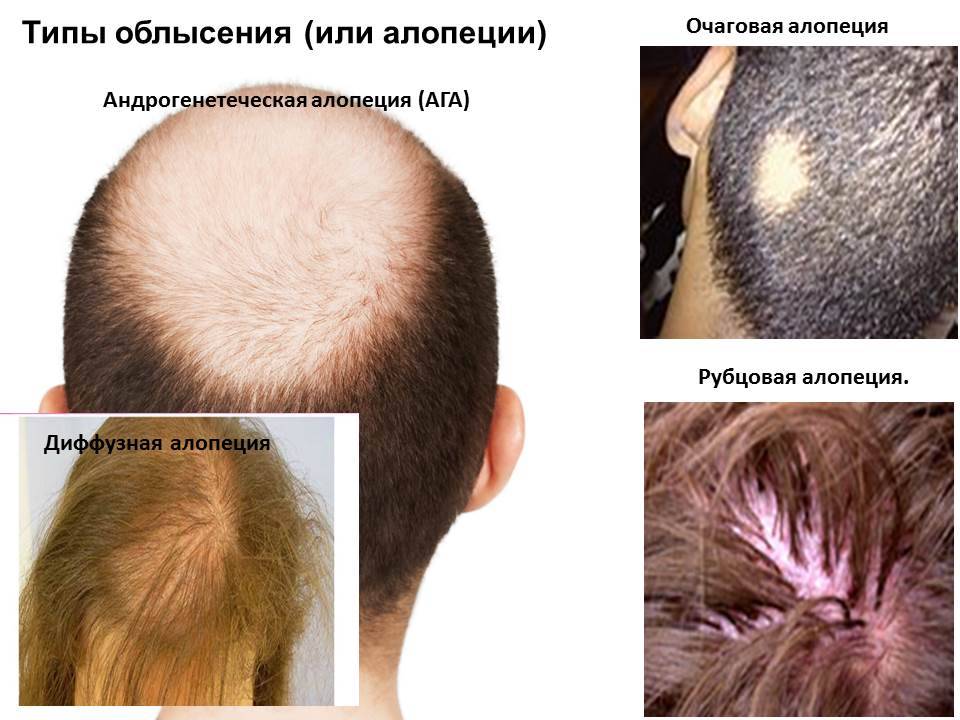 Причины алопеции. лечение облысения у мужчин, у женщин. отзывы