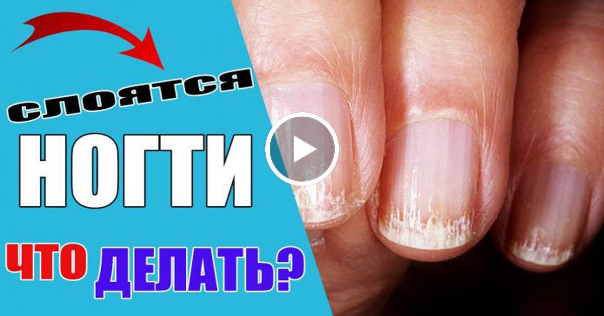 Слоятся ногти на руках - основные причины, советы и лечение
