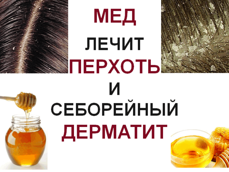 Как быстро и эффективно вылечить себорейный дерматит народными средствами | блоги