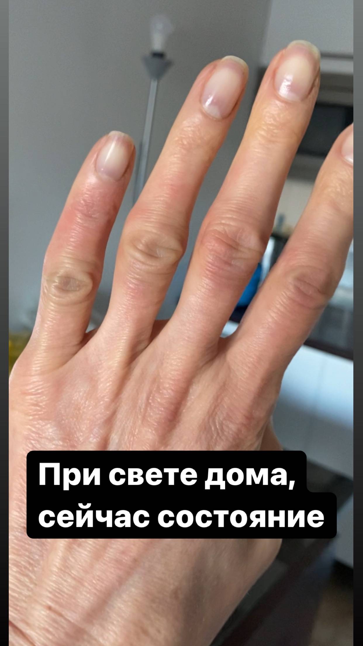 Опух палец