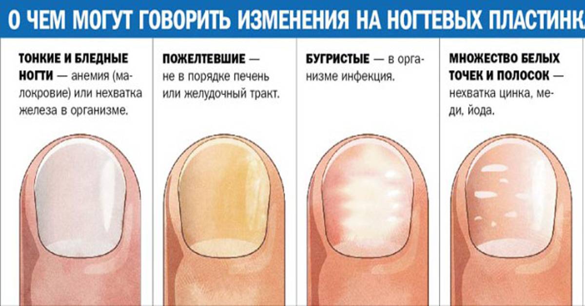 Белые полоски на ногтях– почему появляется лейконихия и как с ней бороться