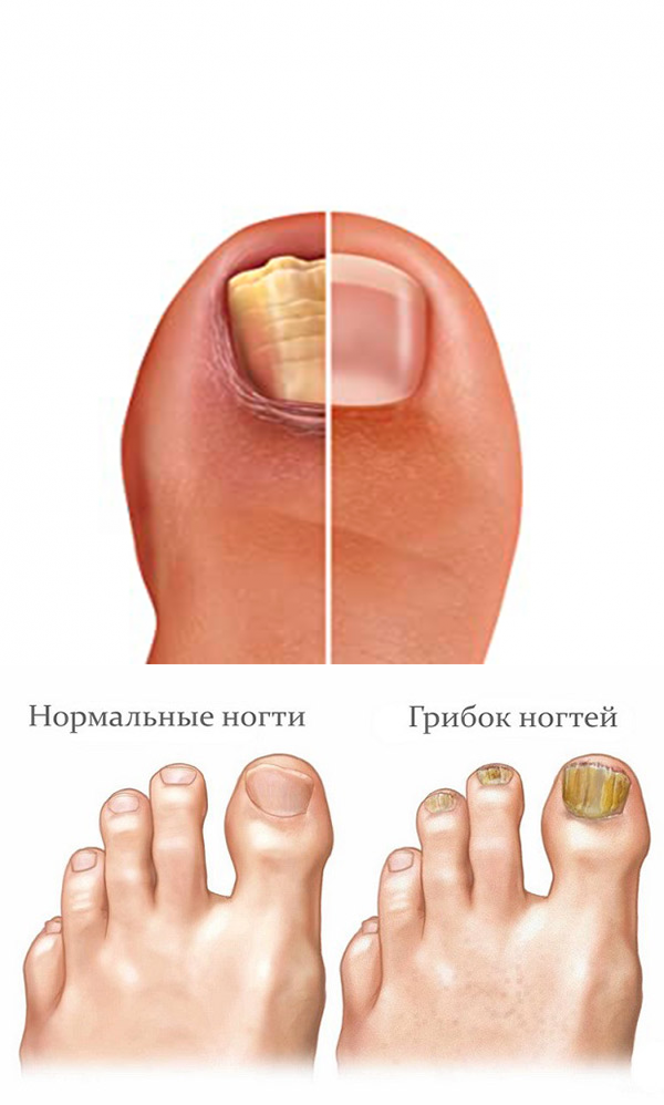 Как выглядит начальная стадия грибка ногтей на руках и ногах?