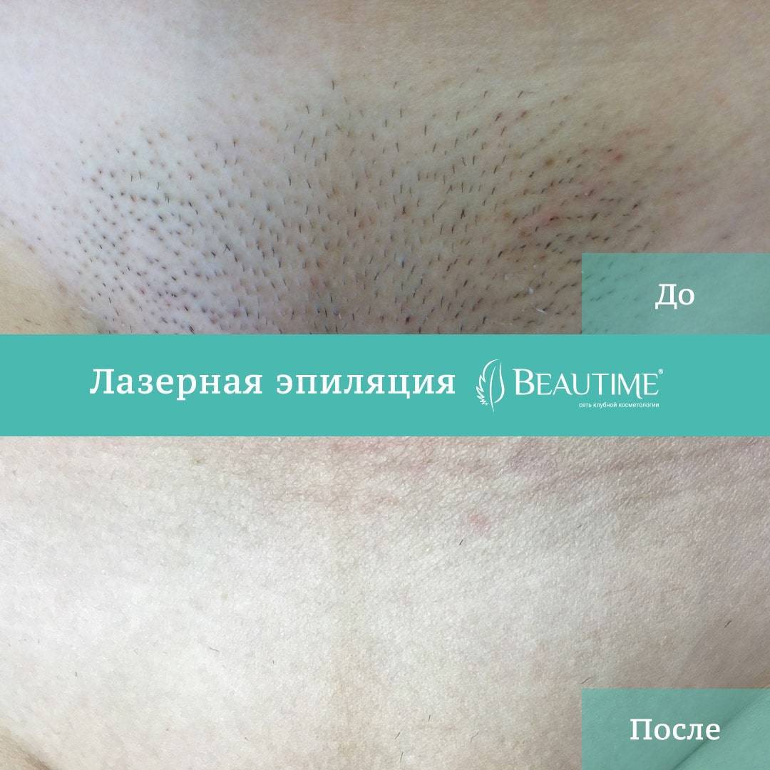 Восковая эпиляция: советы и рекомендации для начинающих