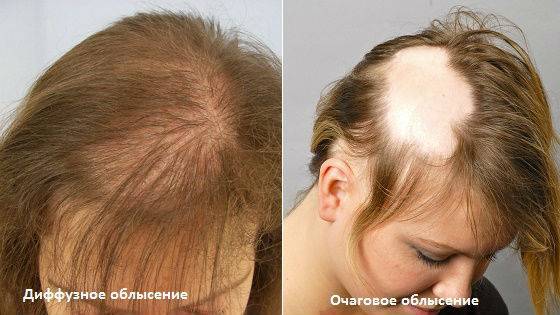 Лучшие эффективные народные средства от выпадения волос – здоровье как усилие воли