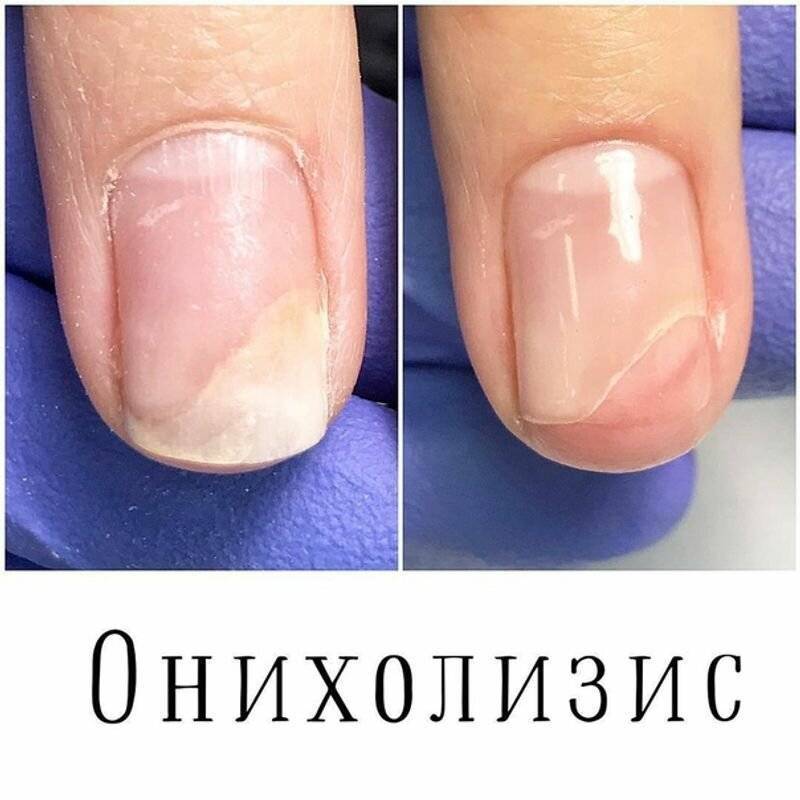 Псориаз ногтей: причины и лечение — статьи специалистов клиники красота здоровья в пятигорске