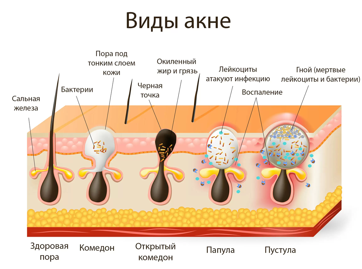 Как избавиться от белых угрей-25 домашних средств. facialskin