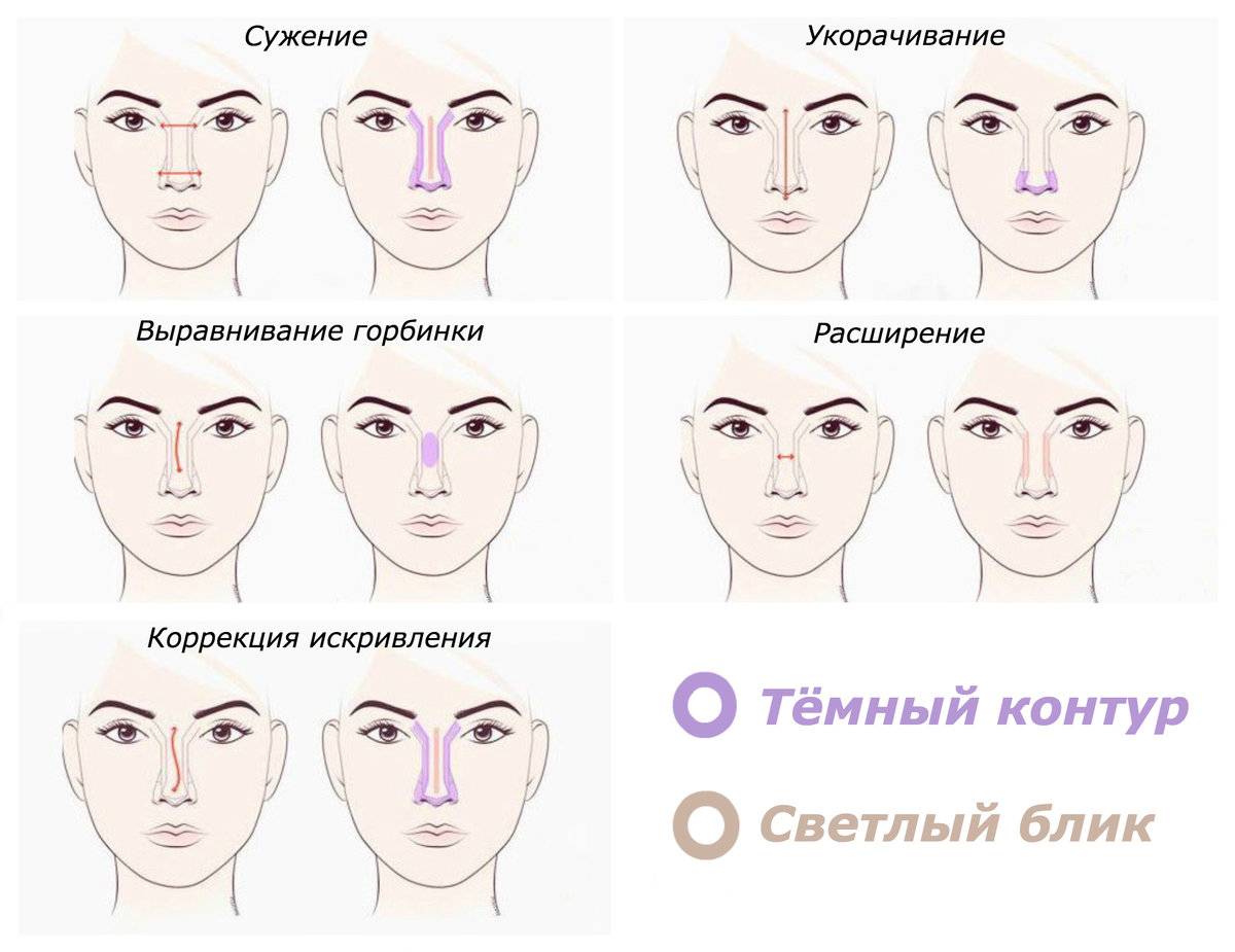 Как исправить форму носа без операции — кончик носа, убрать горбинку — жидкий нос — институт пластической хирургии на трубной