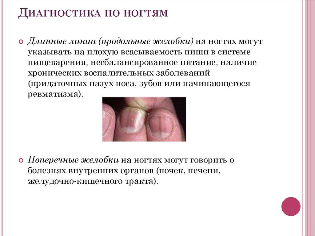 Почему появляются продольные и поперечные полосы на ногтях