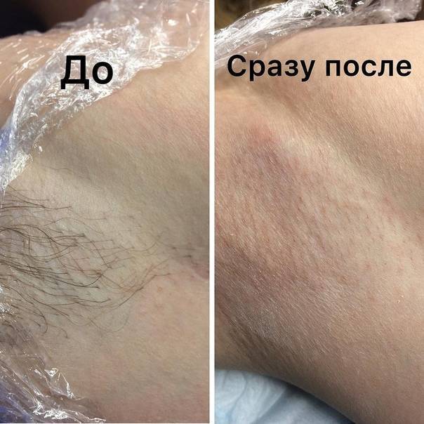 Шугаринг зоны бикини в домашних условиях: как правильно делать самой себе, видео, отзывы