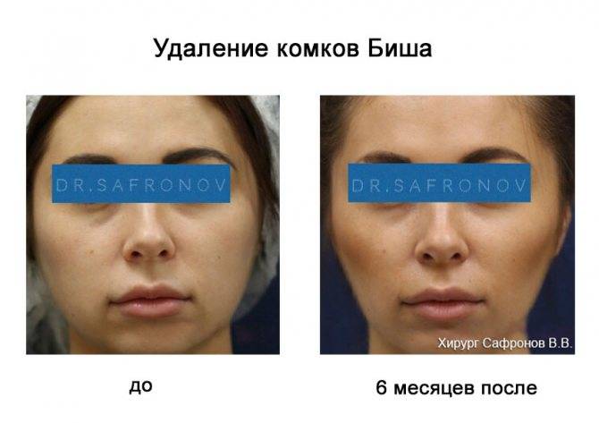 Комочки биша: можно ли убрать без операции?