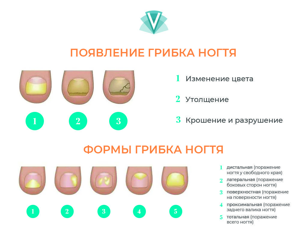 Толстый ноготь на ноге: утолщение на больших пальцах и мизинце, деформация пластины – причины и лечение