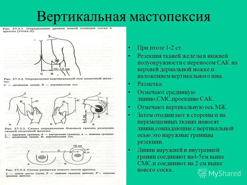 Мастопексия Цена