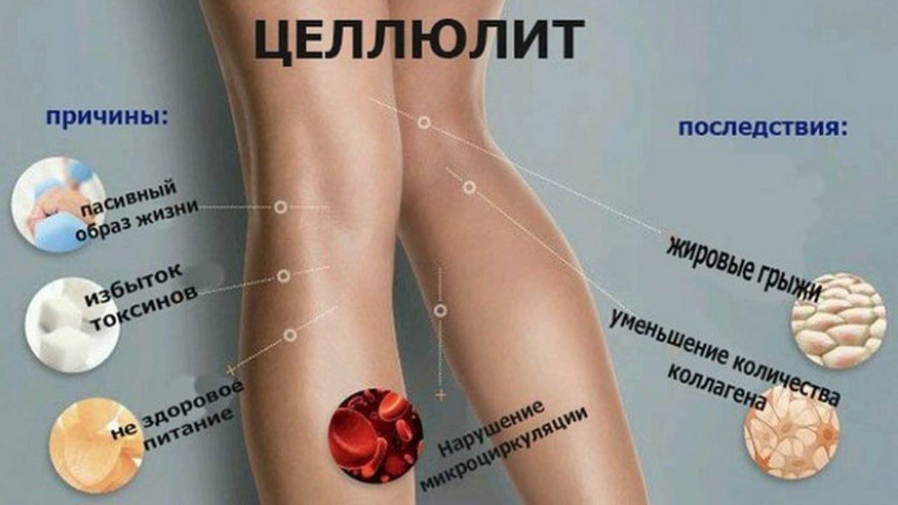 Целлюлит: почему появляется у женщин, почему не уходит