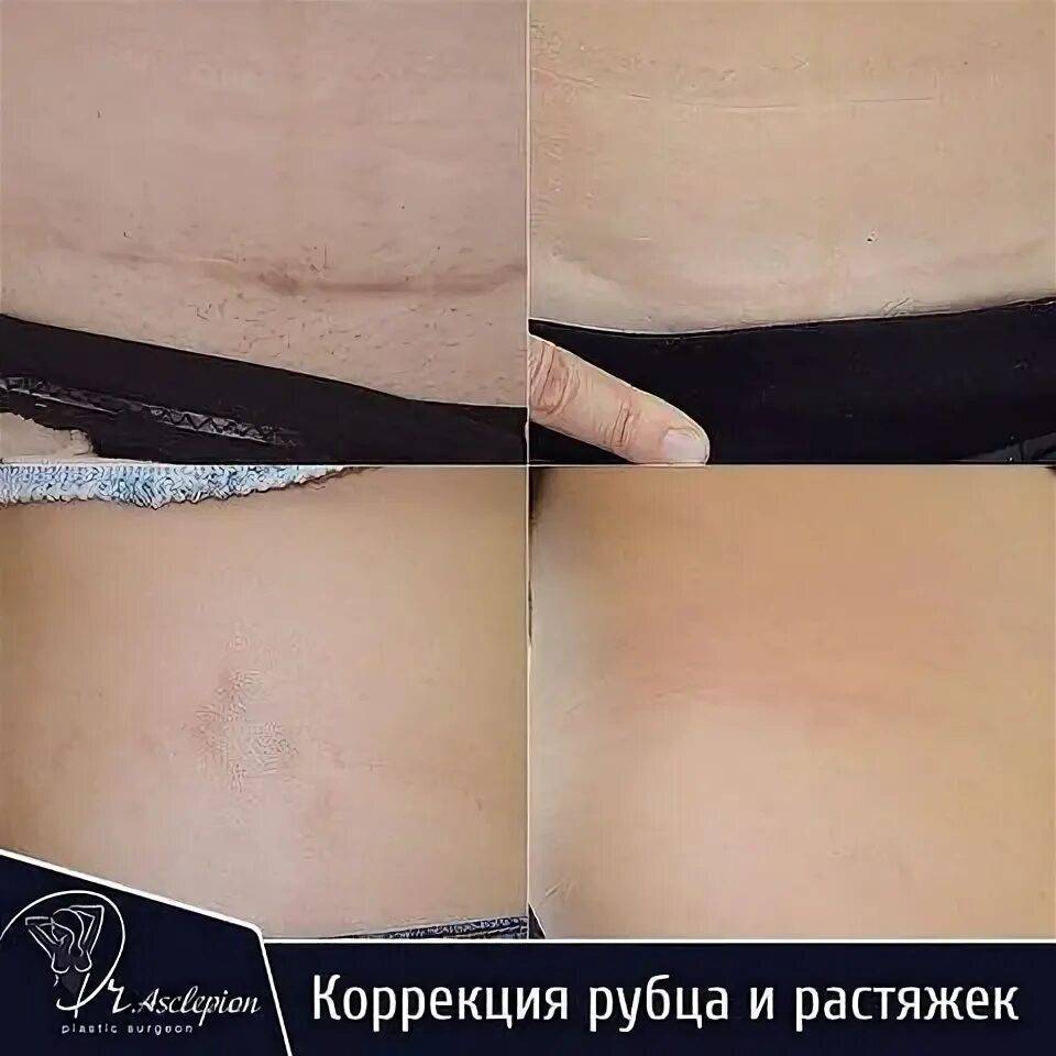 Какие бывают процедуры от растяжек?